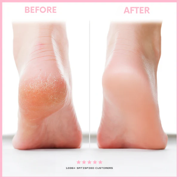 50% Rabatt | Elyssole™ | Professioneller Hornhautentferner