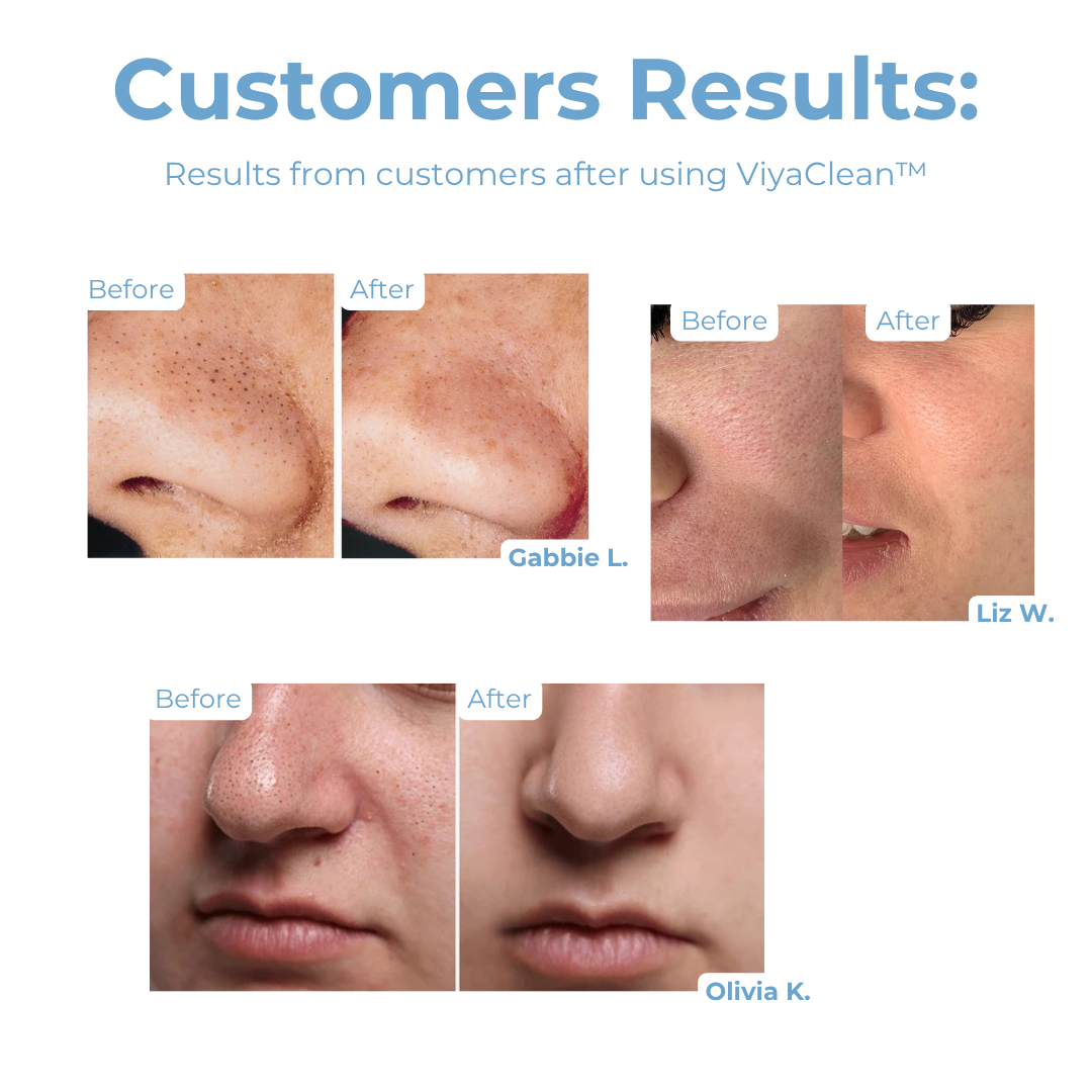 5+5 GRATIS | ViyaClean™ | Porenreinigungs-Serum