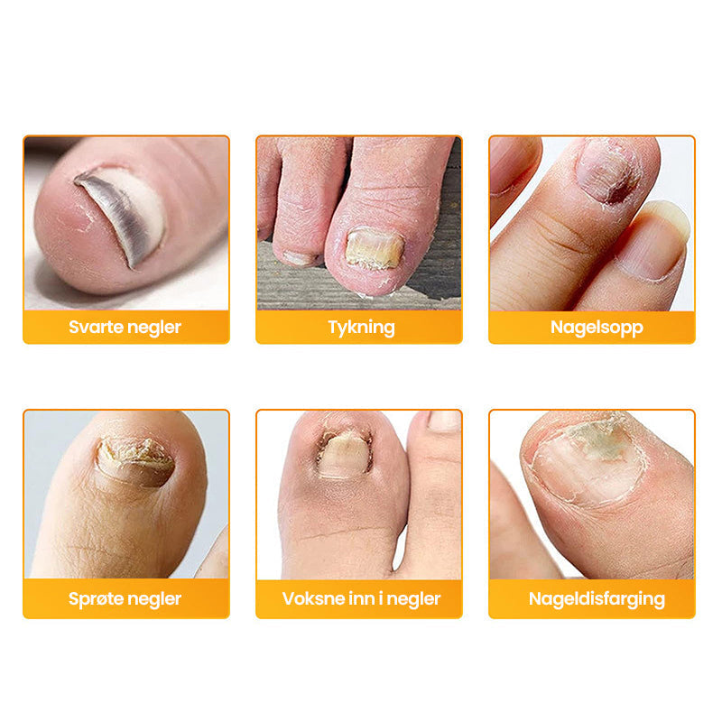 1+1 Gratis | Nailox™  | Wirksame Behandlung von Nagelpilz