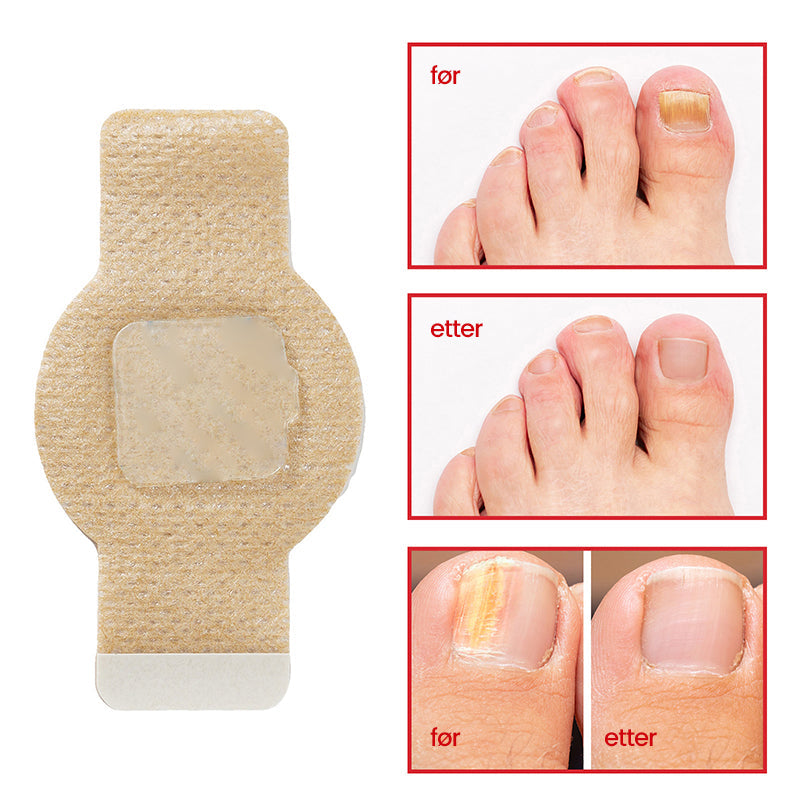 1+1 Gratis | Nailox™  | Wirksame Behandlung von Nagelpilz