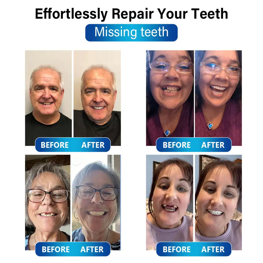 50% RABATT | Futusly™ | Professionelle Blaulicht-Härtelampe und langlebige Prothesenmaterialien