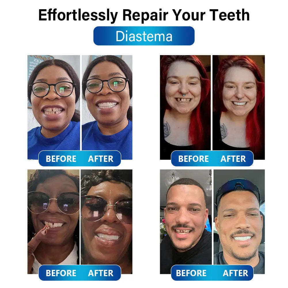 50% RABATT | Futusly™ | Professionelle Blaulicht-Härtelampe und langlebige Prothesenmaterialien