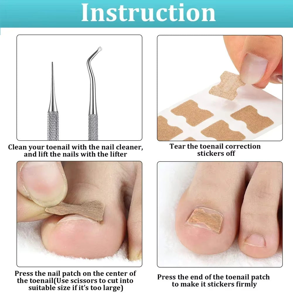 ToePrecise | Ingrown Toenail Tools Set