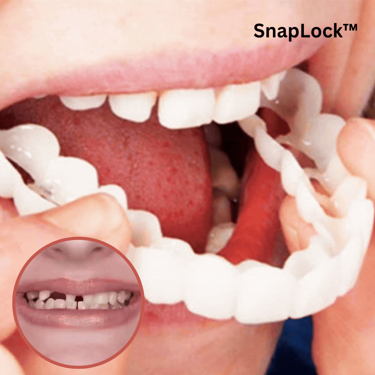 1+1 Gratis | SnapLock™ | Einrastbarer Zahnersatz