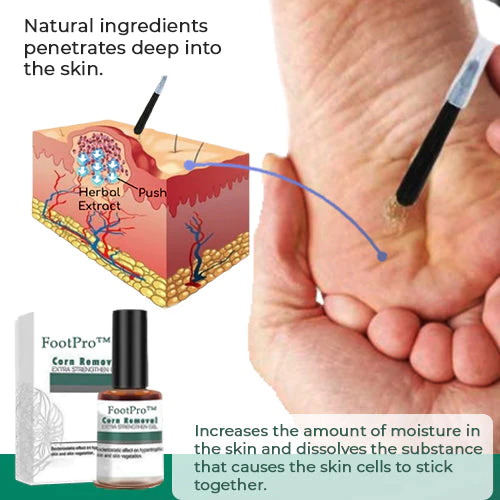 FootPro™ | Hühneraugen Entferner Gel – Schmerzfreies, schnelles und effektives Gel zur sanften Fußpflege und Hornhautentfernung