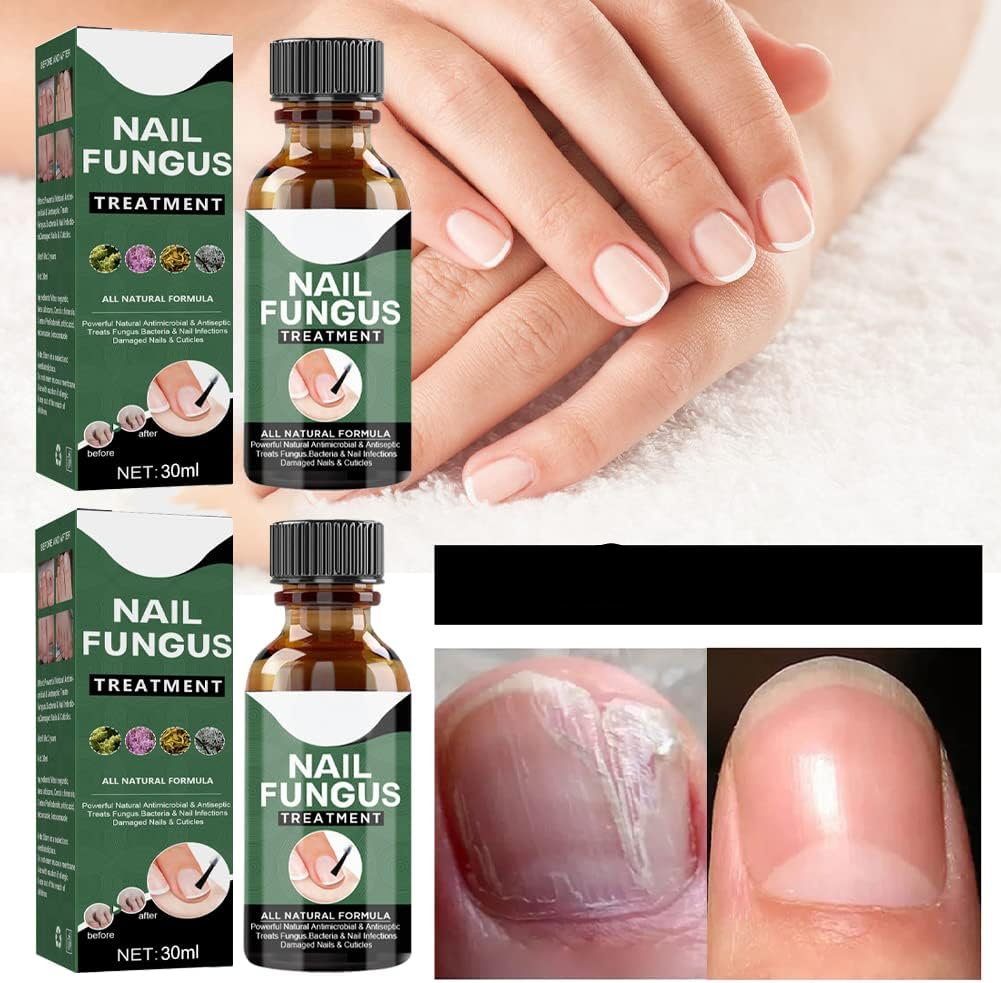 Nagelpilz-Reparaturserum | Heilt, Restauriert & Schützt Beschädigte Nägel