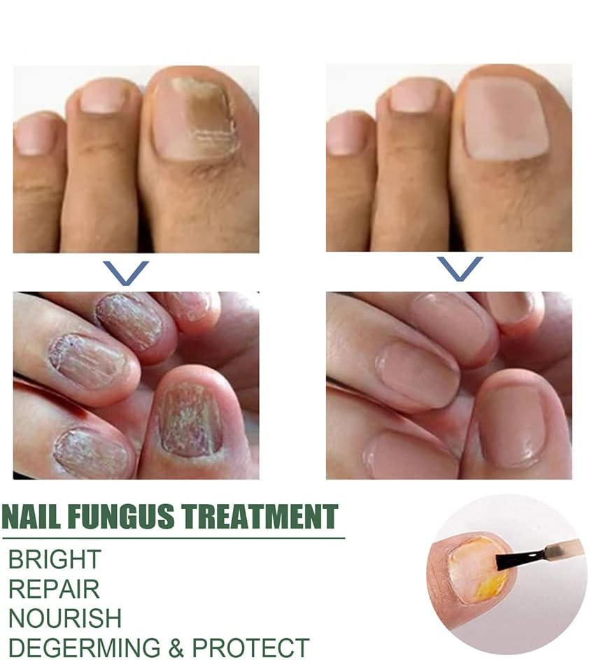 Nagelpilz-Reparaturserum | Heilt, Restauriert & Schützt Beschädigte Nägel