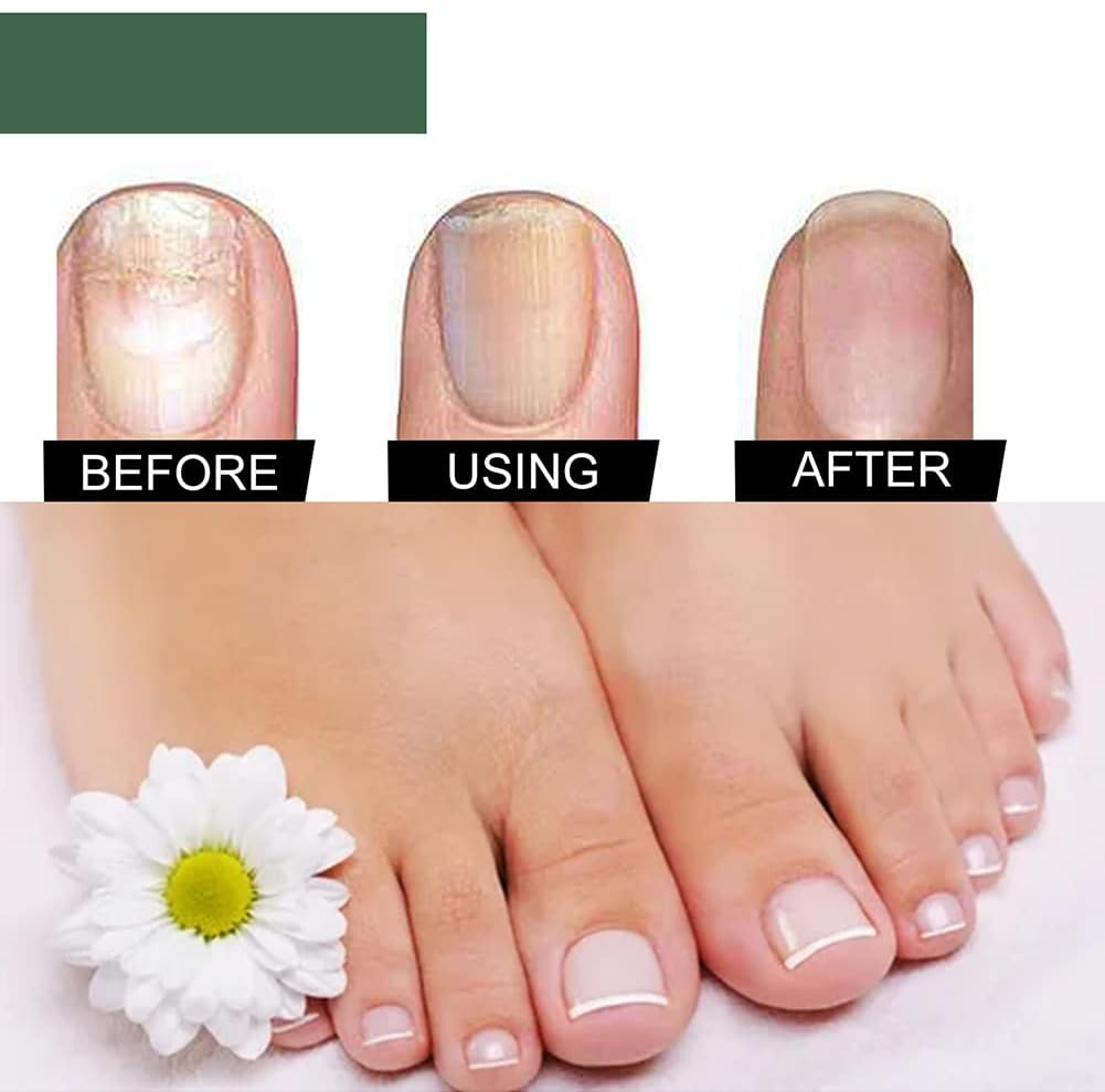 Nagelpilz-Reparaturserum | Heilt, Restauriert & Schützt Beschädigte Nägel