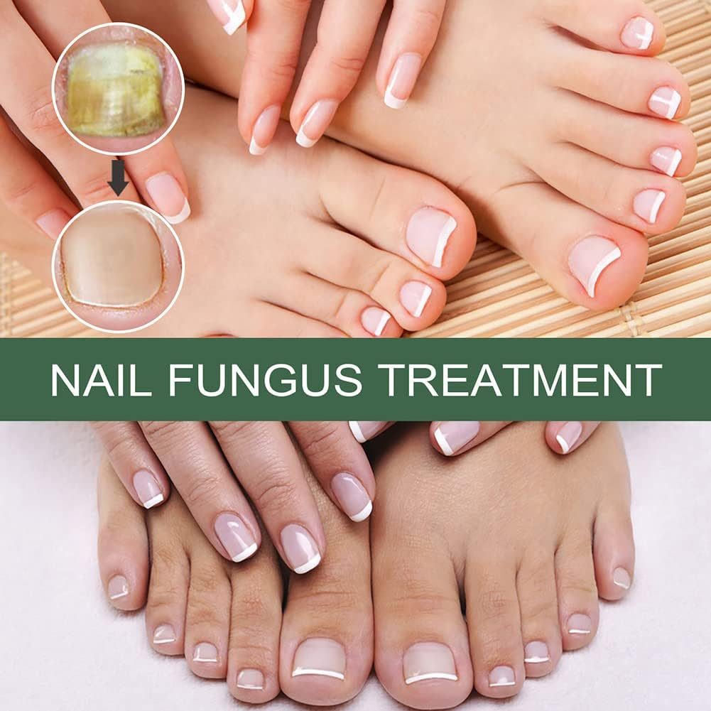 Nagelpilz-Reparaturserum | Heilt, Restauriert & Schützt Beschädigte Nägel
