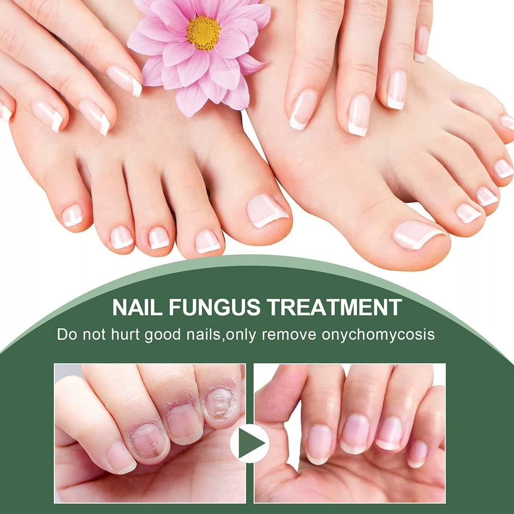 Nagelpilz-Reparaturserum | Heilt, Restauriert & Schützt Beschädigte Nägel