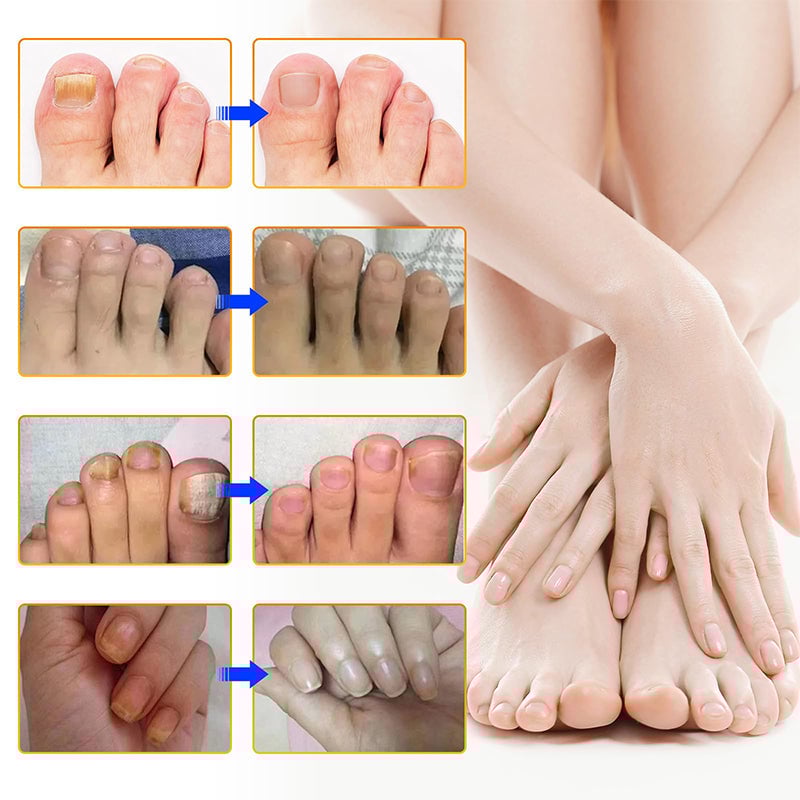 1+1 Gratis | Nailox™  | Wirksame Behandlung von Nagelpilz