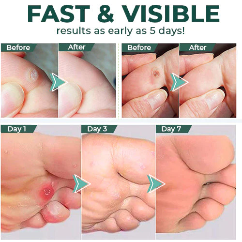 FootPro™ | Hühneraugen Entferner Gel – Schmerzfreies, schnelles und effektives Gel zur sanften Fußpflege und Hornhautentfernung